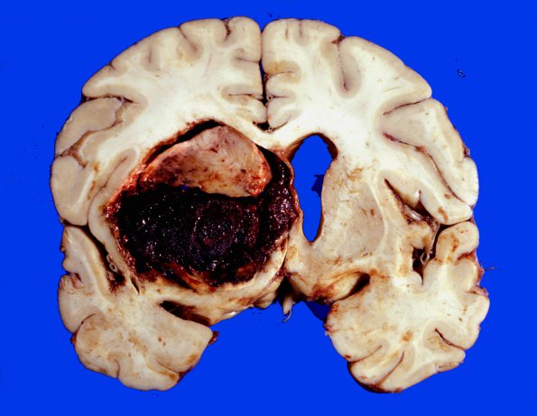 2 Hemorrhage, HT (Case 2) gross 1