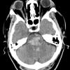 20A Hemorrhage, hypertensive (Case 20) CT - Copy