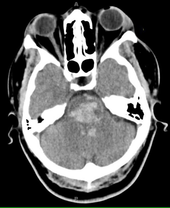 20A Hemorrhage, hypertensive (Case 20) CT - Copy