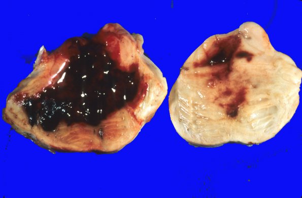 21 Hemorrhage, HT (Case 21)