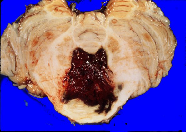 22B Hemorrhage, HT, Pons (Case 22) 1