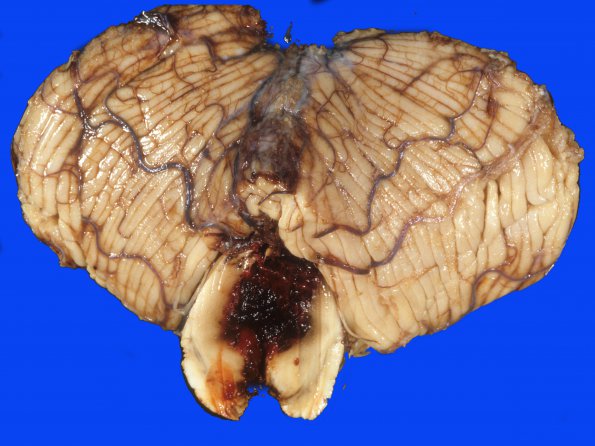 24A Hemorrhage, hypertensive, pons with extension (Case 24) 1