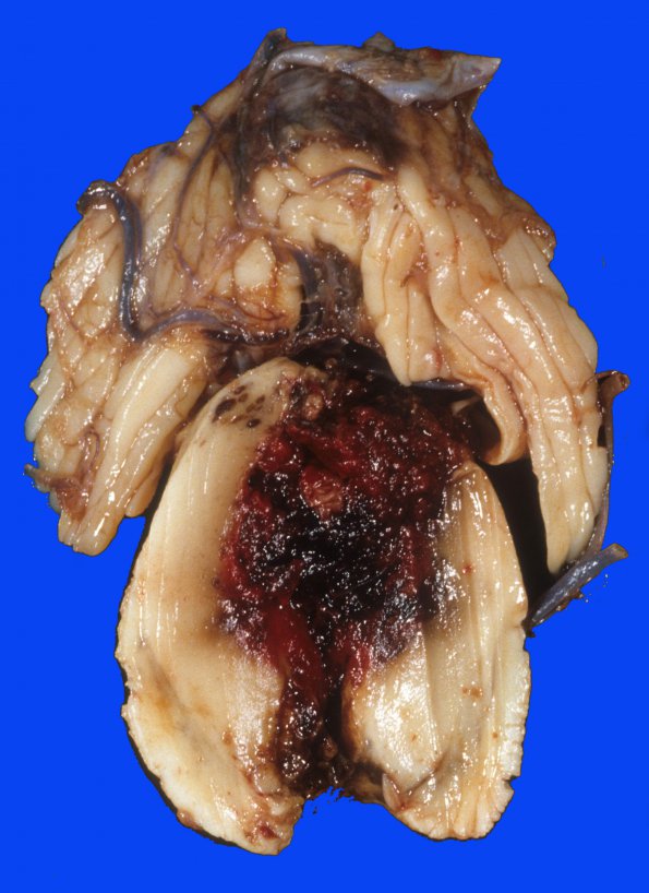 24B Hemorrhage, hypertensive, pons with extension (Case 24) 3