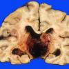24C Hemorrhage, hypertensive, pons with extension (Case 24) 2