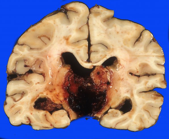 24C Hemorrhage, hypertensive, pons with extension (Case 24) 2