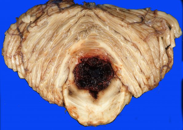 24D Hemorrhage, hypertensive, pons with extension (Case 24) 4