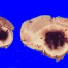 25 Hemorrhage, hypertensive (Case 25)