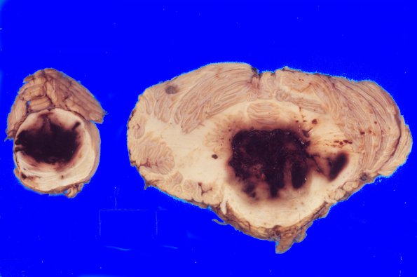 25 Hemorrhage, hypertensive (Case 25)