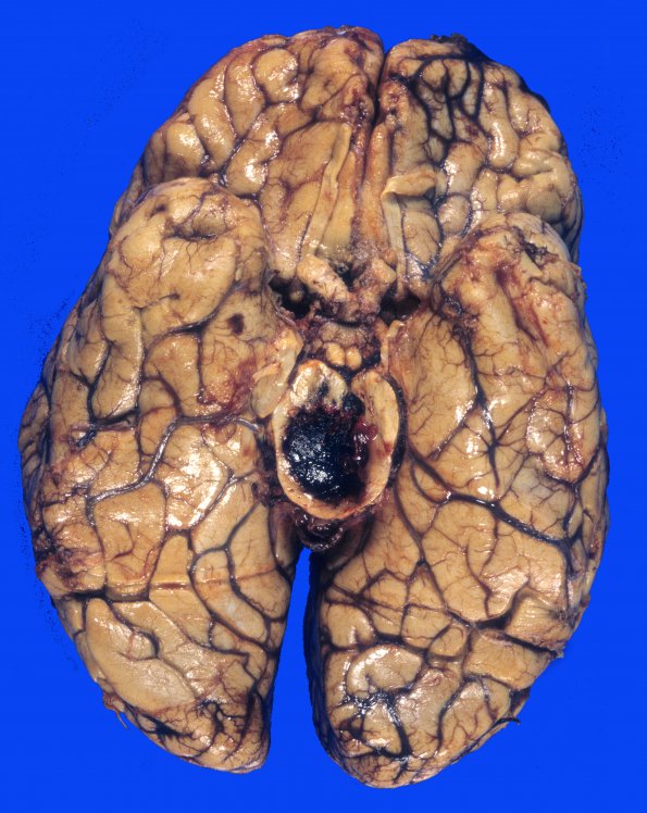 26A Hemorrhage, hypertensive (Case 26) 4