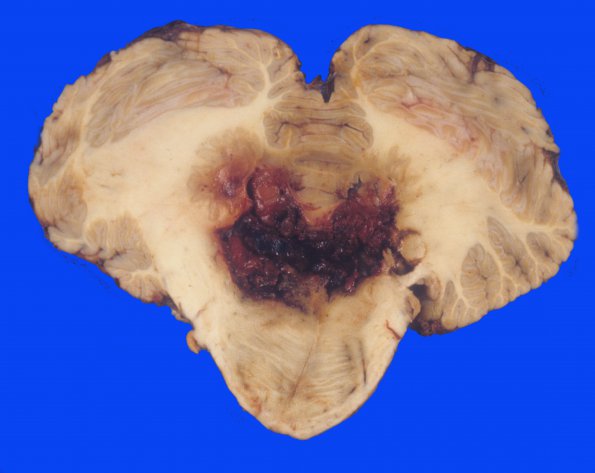 27 Hemorrhage, hypertensive (Case 27) 3