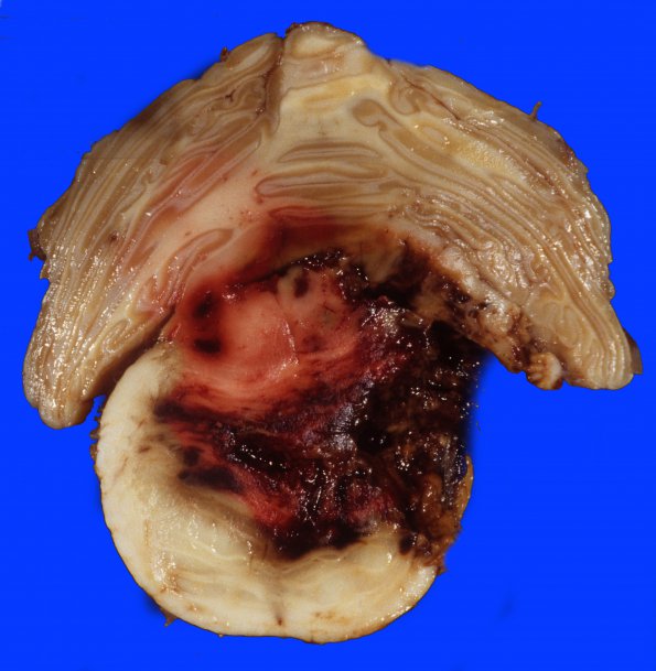 28 Hemorrhage, hypertensive (Case 28) 2