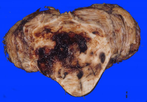 29 Hemorrhage, hypertensive (Case 29) 2