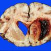 3 Hemorrhage, HT (Case 3) gross 1