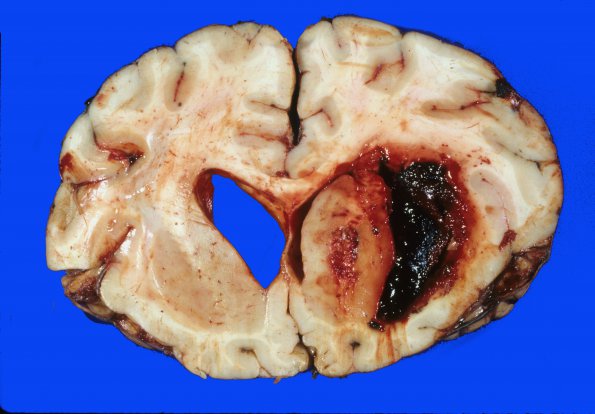 3 Hemorrhage, HT (Case 3) gross 1