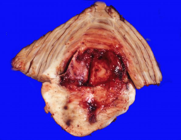 30 Hemorrhage, HT (Case 30) 2