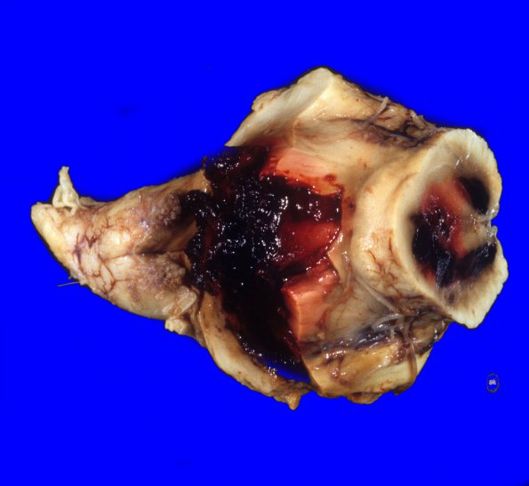 31A Hemorrhage, hypertensive, pons & Watershed (Case 31) 5