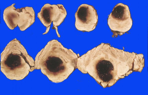 32 Hemorrhage, hypertensive (Case 32) 1