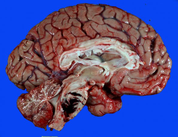 34A Hemorrhage, hypertensive (Case 34) _2