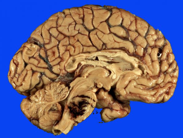 34B Hemorrhage, hypertensive (Case 34) _5