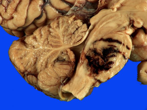 34C Hemorrhage, hypertensive (Case 34) _6