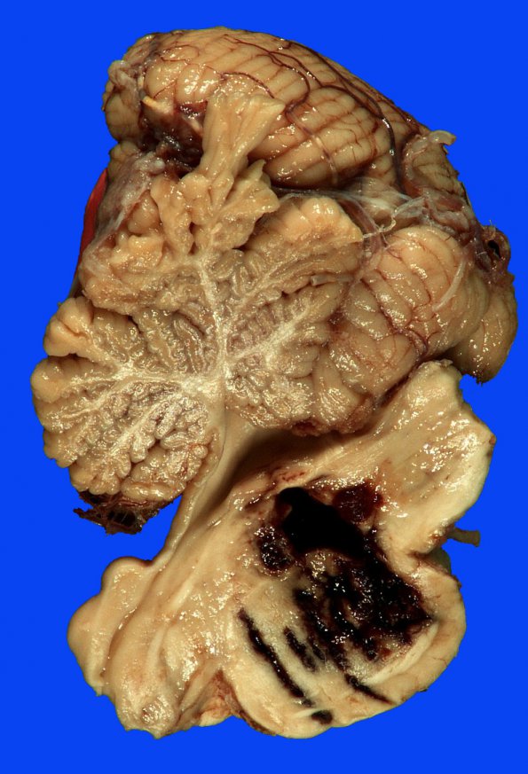 34D Hemorrhage, hypertensive (Case 34) _7