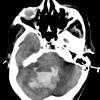 35A Hemorrhage, hypertensive, cerebellum (Case 35) CT - Copy - Copy