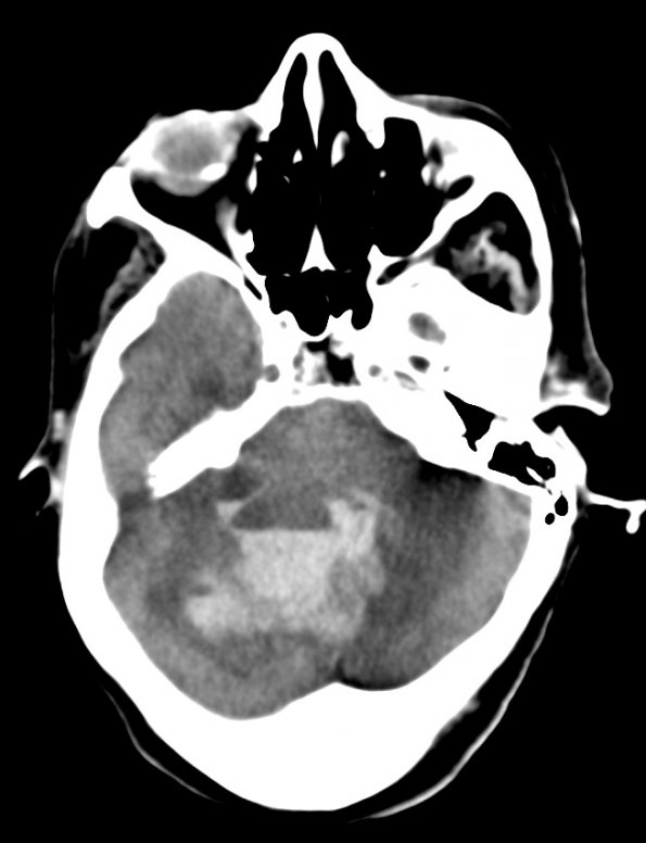 35A Hemorrhage, hypertensive, cerebellum (Case 35) CT - Copy - Copy