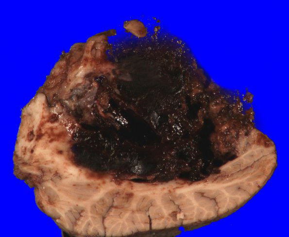 35B Hemorrhage, hypertensive, cerebellum (Case 35) Gross_5