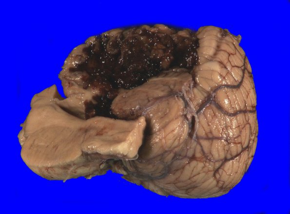 36A Hemorrhage, hypertensive, cerebellum (Case 36) _4