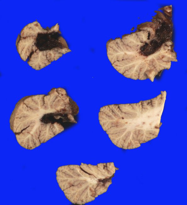 36B Hemorrhage, hypertensive, cerebellum (Case 36) _5