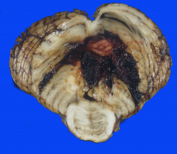 37A Hemorrhage, hypertensive (Case 37) 1