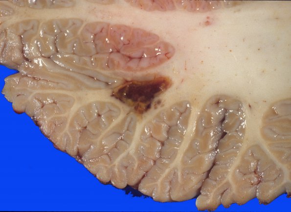 38 Hemorrhage, hypertensive (Case 38)