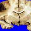 39A Hemorrhage, HT (Case 39) 2