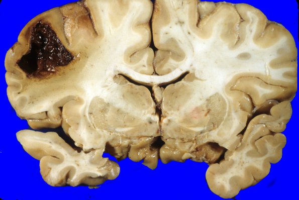 39A Hemorrhage, HT (Case 39) 2