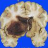 4 Hemorrhage, hypertensive (Case 4) 3