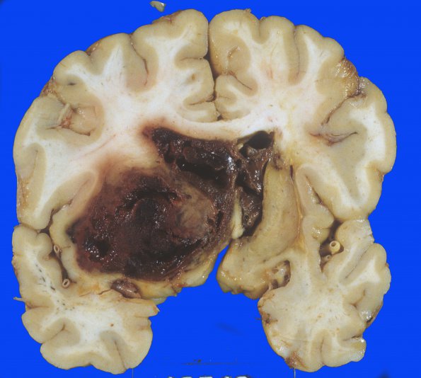 4 Hemorrhage, hypertensive (Case 4) 3