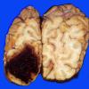 40 Hemorrhage, coagulopathy vs cocaine (Case 40) 2