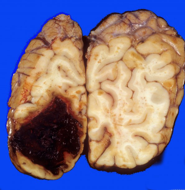 40 Hemorrhage, coagulopathy vs cocaine (Case 40) 2