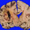 41 Hemorrhage, hypertensive (Case 41)