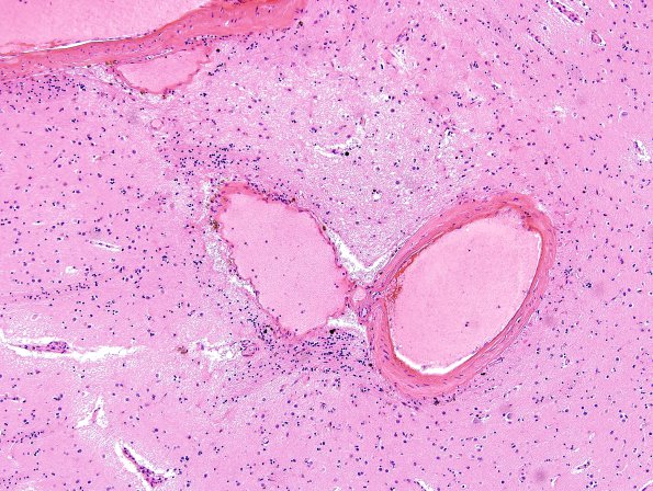 43A Hypertension, Charcot Bouchard (Case 43) H&E 2