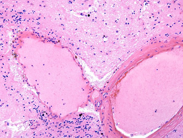 43B Hypertension, Charcot Bouchard (Case 43) H&E 1