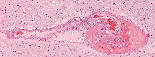 44A Hypertension (Case 44) (Charcot-Bouchard) Aneurysm H&E 2