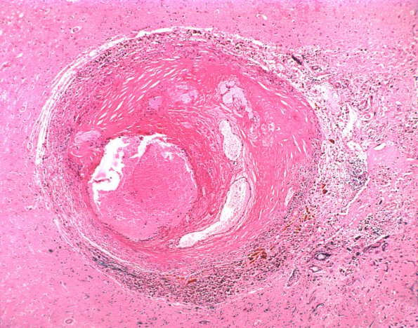 45B Hypertension, Charcot Bouchard Aneurysm (Case 45) H&E 1