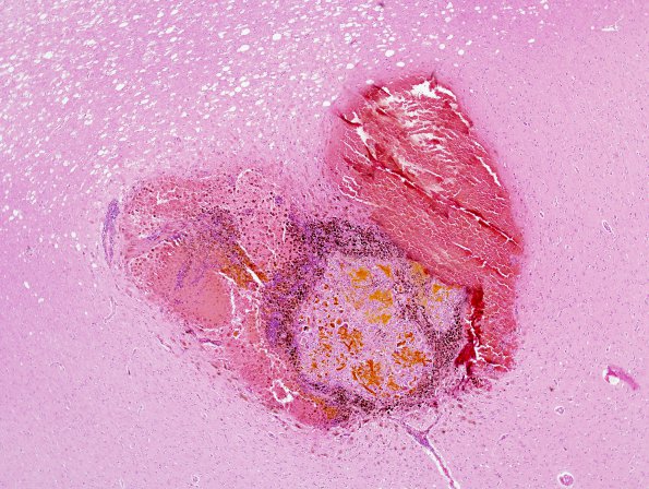 48A2 Hemorrhage, HT, subcortical (Case 48) H&E 1