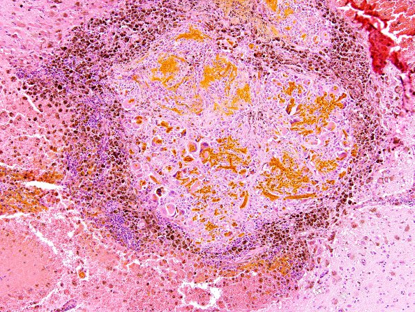 48A4 Hemorrhage, HT, subcortical (Case 48) H&E 2