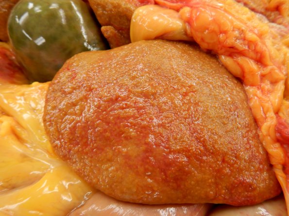 49A Liver Cirrhosis (A20-76)