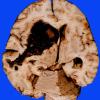 5 Hemorrhage, hypertensive (Case 5)