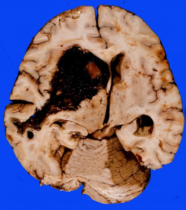 5 Hemorrhage, hypertensive (Case 5)