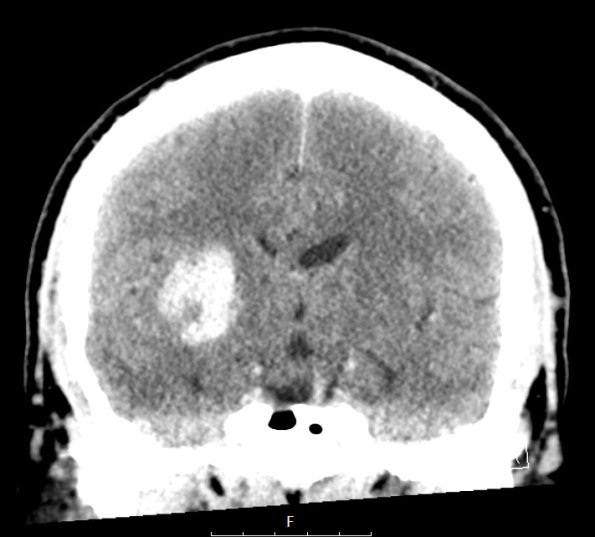 50A1 (Case 50) CT A - Copy