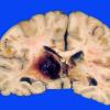 6 Hemorrhage, hypertensive (Case 6)